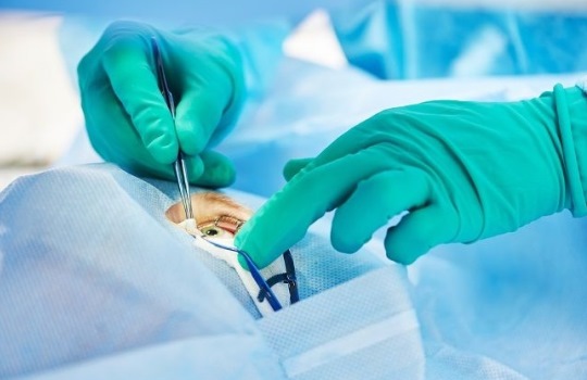 Pertimbangan Sebelum Menjalani Prosedur LASIK Mata